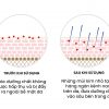 Máy Đẩy Tinh Chất Hàn Quốc WHISIS Nano Chip Derma Pen Mờ Nám, Giảm Nếp Nhăn